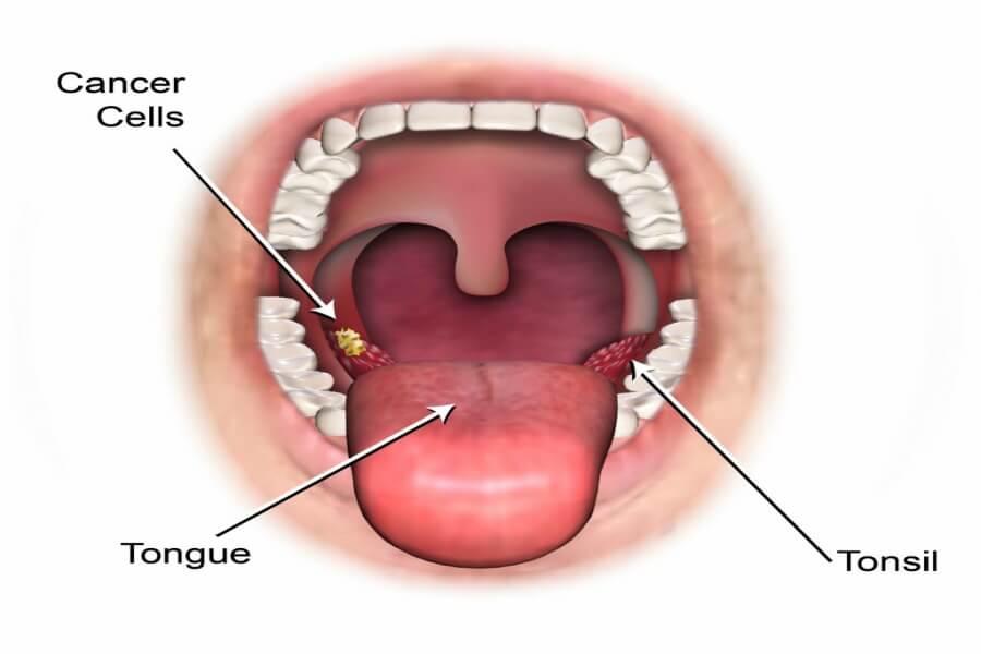 Cancer of the Throat and HPV